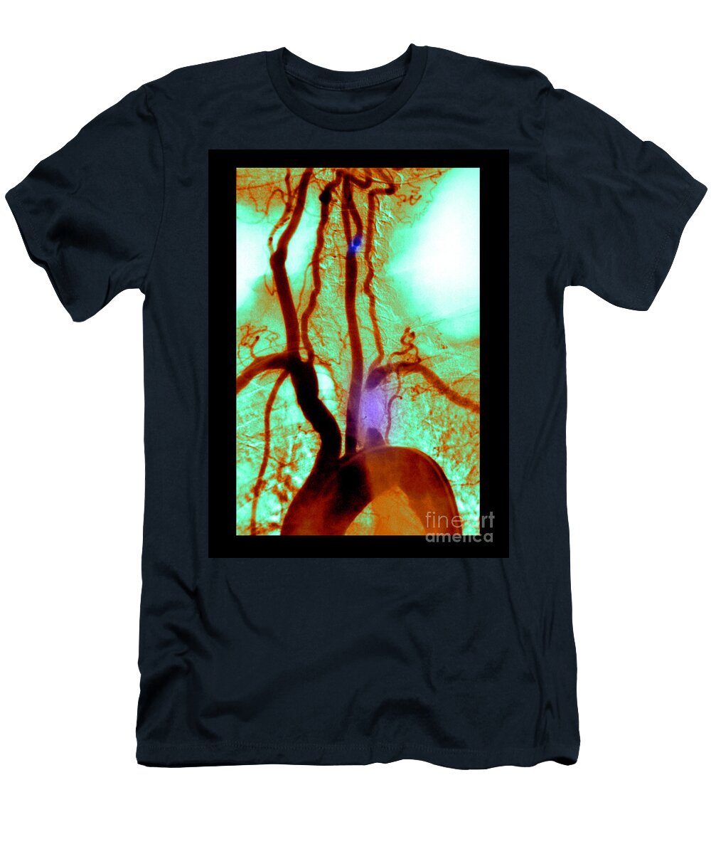 1 Aortic Arch Angiogram Medical Body Scans T-Shirt